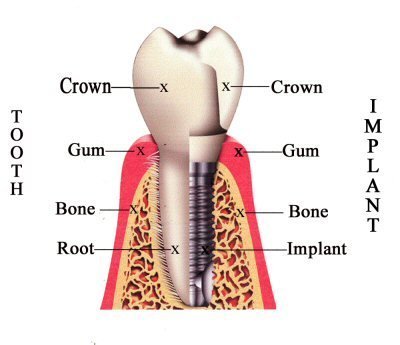 The anatomy of a dental implant
