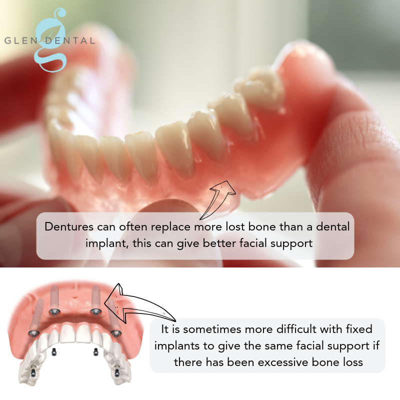 Denture can often replace more lost bone then a dental implant, this can give better facial support