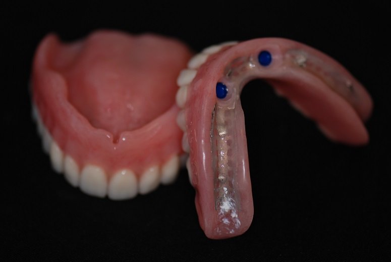 denture options with just canines remaining - The fitting in the denture