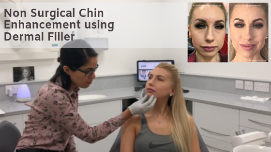 Nonsurgical chin enhancement using dermal filler