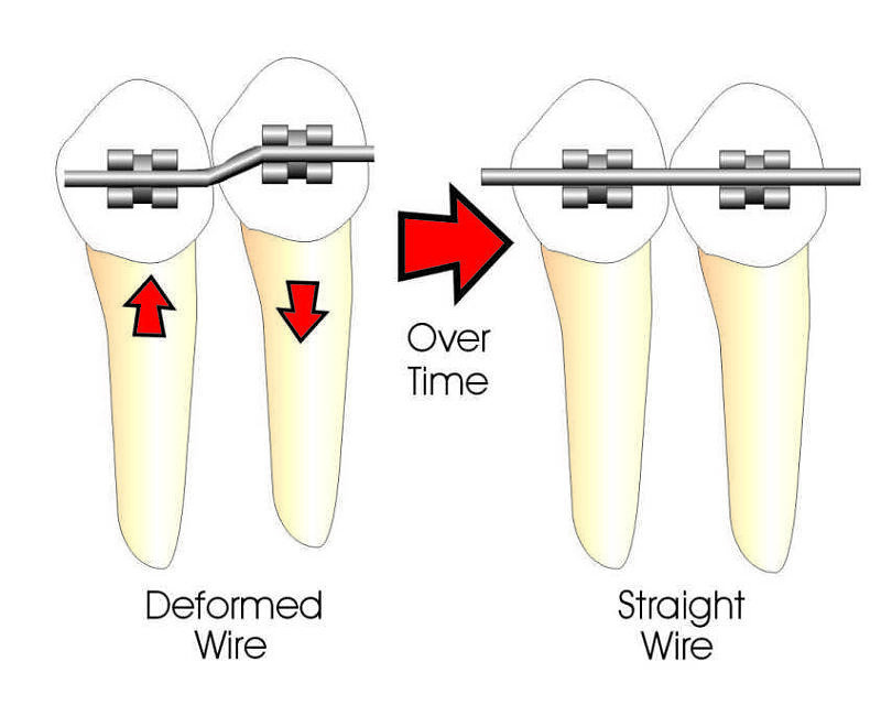 Braces And Orthodontics Your Dental Health Glen Dental 