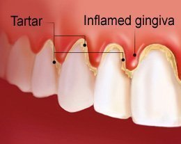 Tartar buildup around tooth Causing gingivitis