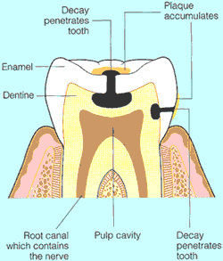 Dental cavities forming