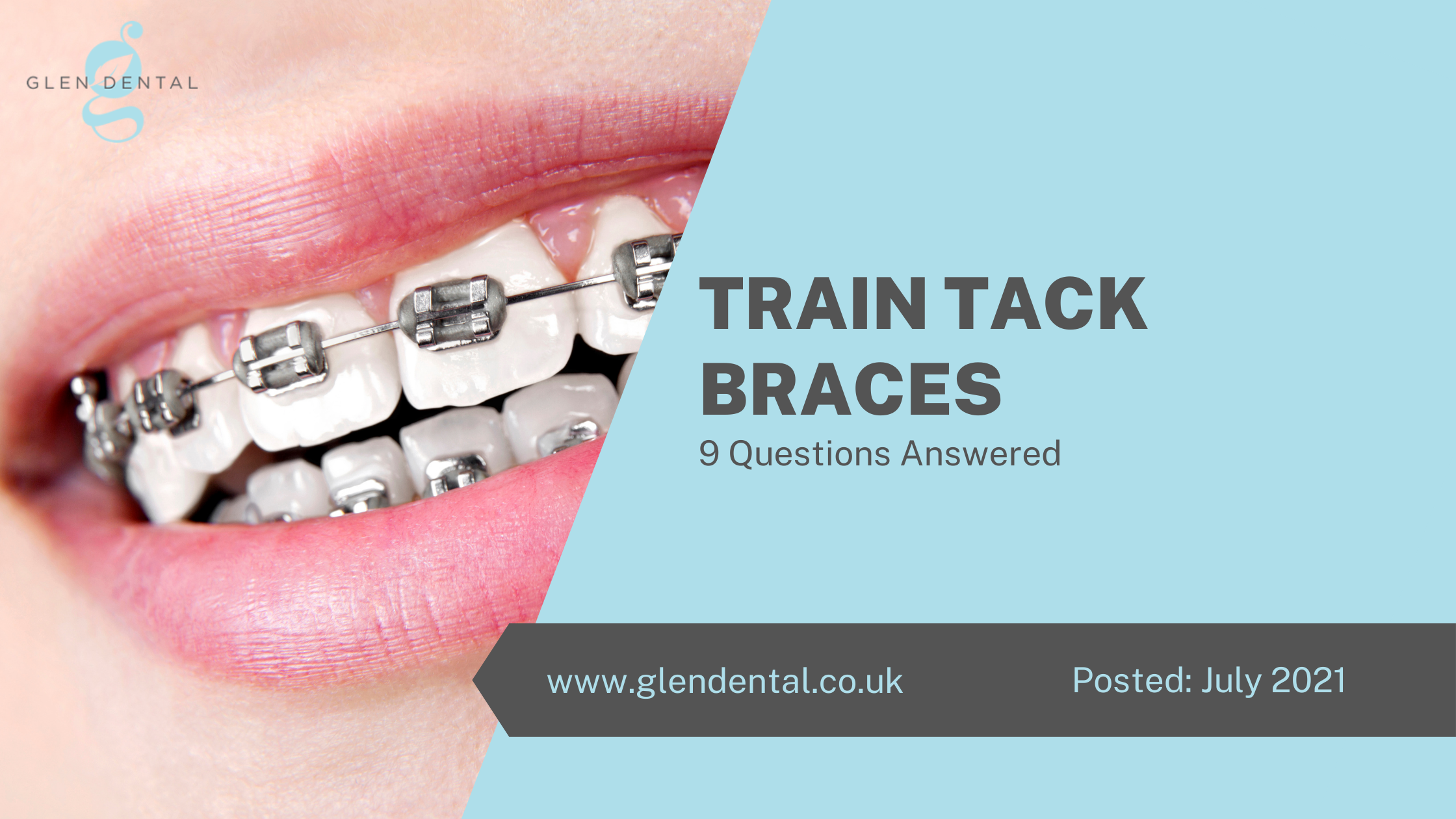 Train Tack Braces - 9 Questions Answered